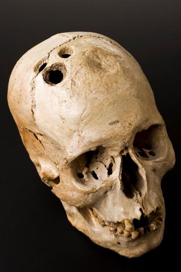 Figure 1. This skull from Palestine is about 2,000 years old and shows four separate holes made by trepanation.  [Science Museum, London](https://wellcomecollection.org/works/va96ydta)